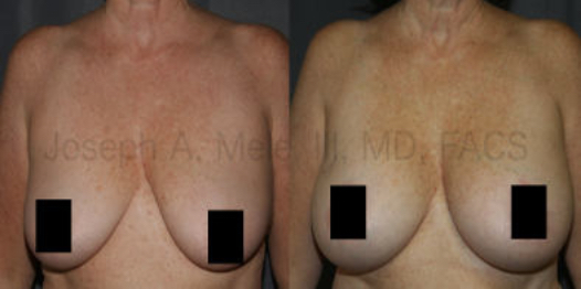 Breast Aug Lift No Vertical Scar Dr Mele