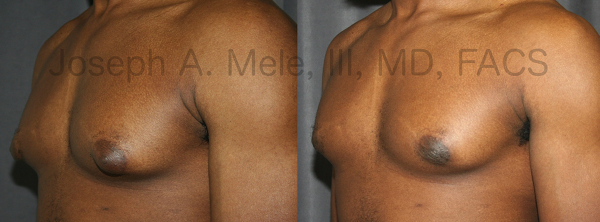 Amount Of Tissue Removed With Breast Reduction 98