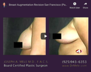 Breast Augmentation Revision Surgery Video Presentation with before and after pictures