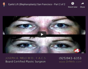 Blepharoplasty Video Presentation with eyelid lift before and after pictures