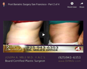 Post-Bariatric Plastic Surgery Video Presentation with before and after photos