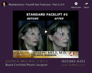 Facelift Video Presentation (Neck Lifts) with before and after photos