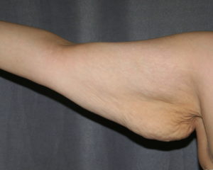 Right Arm after weight loss and before Arm Lift (Brachioplasty)