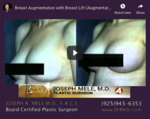 Breast Augmentation and Breast Lift Video Presentation (Mastopexy Augmentation)