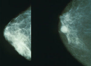 Mammogram