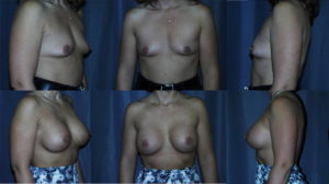 Tubular Breast Augmentation