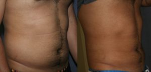 Liposuction of the Abdomen and Flanks - Male