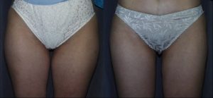 Liposuction (SAL) of the Thighs