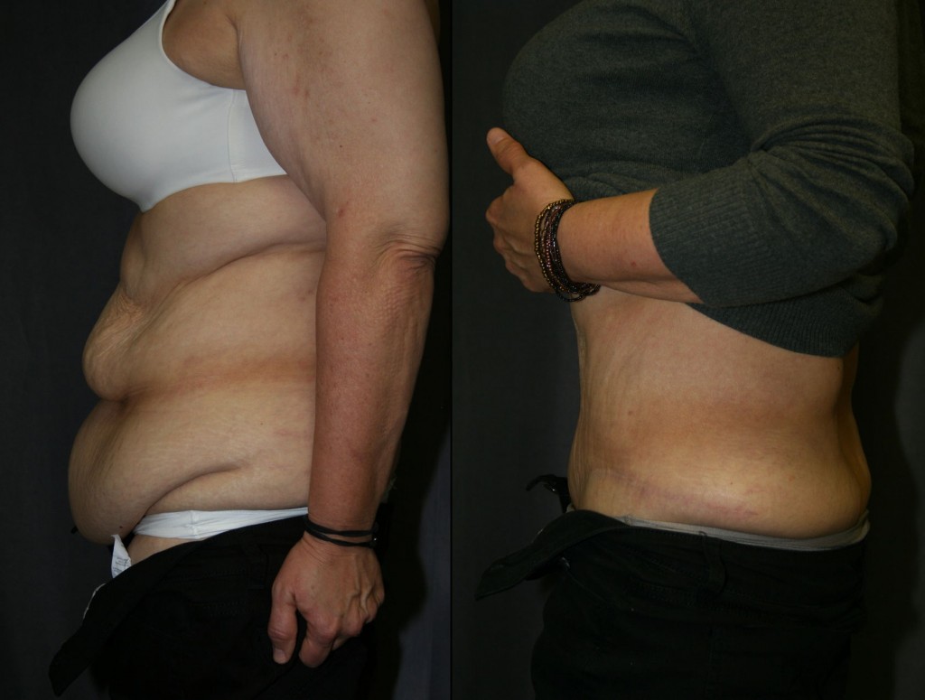 Is the Tummy Tuck Belt As Effective As Abdominoplasty?