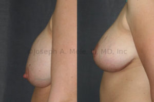 This patient had breast augmentation prior to becoming pregnant. Left: After pregnancy, the breast implant position remains unchanged; however, the breasts have dropped. Right: After breast augmentation revision, the breasts have been lifted and the breast implants exchanged, dramatically improving the breasts' shape and profile.