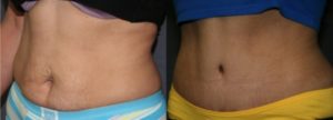 Walnut Creek Abdominoplasty (Tummy Tuck) San Francisco Bay Area