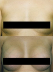 Breast augmentation with teardrop shaped breast implants.