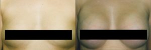 Breast augmentation with teardrop shaped breast implants.