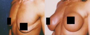 Submuscular Breast Augmentation with Round Breast Implant (Thin Coverage) Before and After Pictures