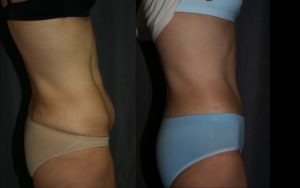 Tummy Tuck Before and After