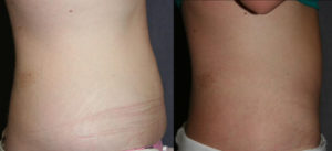 Mini Tummy Tuck Before and After (Mini Abdominoplasty)