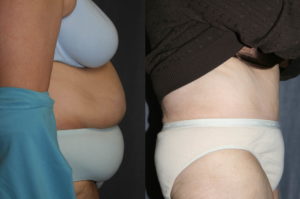 Post Bariatric Plastic Surgery - Tummy Tuck (Abdominoplasty)