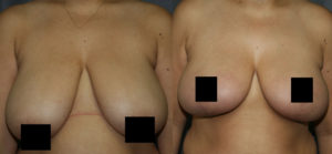 Breast Lift for Larger Breasts