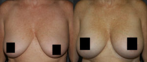 Breast Lift with Breast Augmentation Before and After