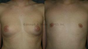 Large amounts of gynecomastia have a feminizing effect on the chest. After gynecomastia reduction the chest is decidedly masculine.