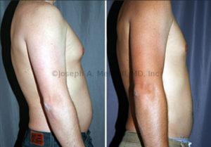 Softer forms of gynecomastia can be removed with liposuction alone. Liposuction was performed on the chest and abdomen in the before and after picture shown above.