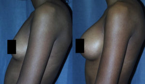 Breast that have always been small have an advantage when it comes to Breast Augmentation.