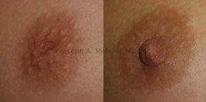 This perfectly formed nipple was hiding. A simple in office inverted nipple repair corrected the problem.