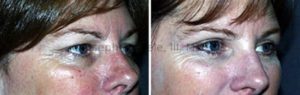 Blepharoplasty (Eyelid Lift) Before and Afters: In our 40's we start to notice facial aging. Though body procedures are still the most popular, the eyelids begin getting some extra attention.