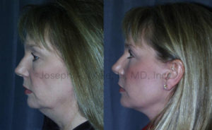 Rhytidectomy (Face Lift) Before and After Photos: In our 50 and 60's our faces begin to sag. Lifts like Face Lifts, Brow Lifts and Eyelid Lifts become even more popular.