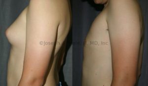 Adolescent Gynecomastia - A common time for presentation, and correction is at adolescent.