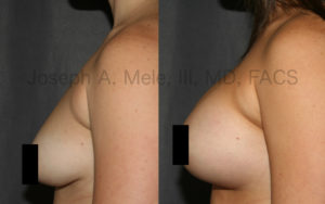 Breast Augmentation can Enlarge Small Breasts or Restore Lost Volume after Pregnancy or Weight Loss.