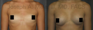 Choosing the right size for you is the most important aspect of Breast Augmentation.