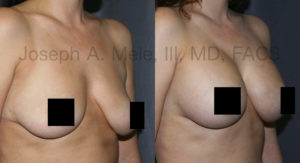 Breast Augmentation remains the most popular Cosmetic Plastic Surgery.