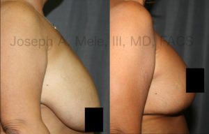 Breast Reduction relieves pain while improving physical appearance, by restoring body proportions.