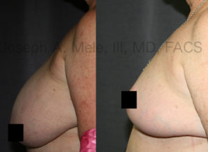 Breast Reduction surgery reduces and lifts the breast, relieving torque on the neck, back and shoulders.