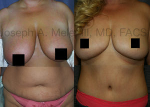 Observant readers may have noticed the similarities between the Breast Reduction and Tummy Tuck pictures above. They are in fact the same person. Above the results combined.