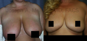 Some Mommy Makeovers include a Breast Reduction rather than Breast Augmentation.