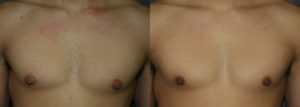 Gynecomastia Reduction Surgery is designed to masculinize the chest.