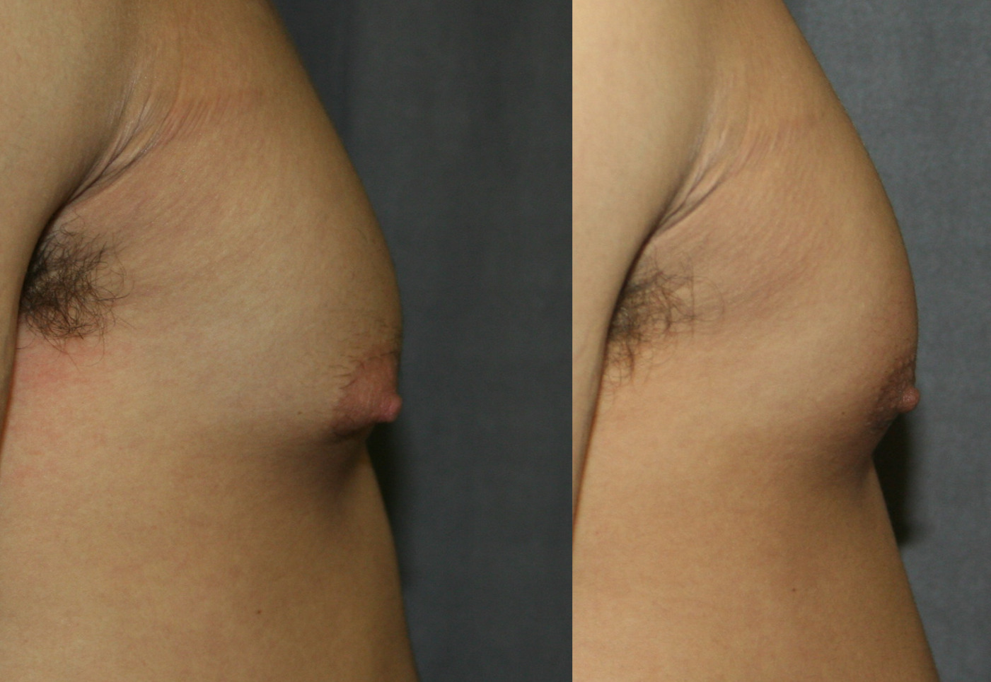 Gynecomastia Reduction for Puffy Nipples | Dr Mele