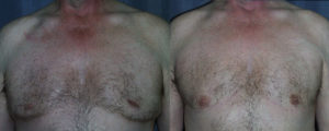 The more extreme the gynecomastia, the more extreme the treatment. Here not only was excess breast tissue removed, but excess skin was also excised.