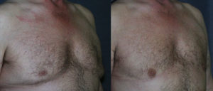 This patient has had gynecomastia reduction, with improvement in the size of the chest; however, he was left with overreaction beneath the nipples and excess skin. By replacing tissue beneath the nipples and removing the excess skin a more aesthetic result is obtained.