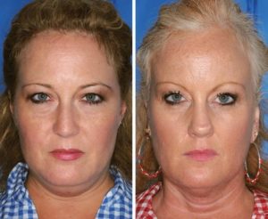 Can you tell which twin smokes? The twin in blue (on the left) is the non-smoker. The twin in red (on the right) has advanced signs of aging: marked loss of mid and lower face fullness, deeper nasolabial folds and smoker's lines around the lips.