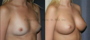 Saline or Silicone? Saline and Silicone Breast Implants feel different, but give similar results visually.