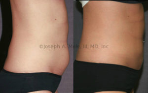 Liposuction removes disproportionate fat and allows the skin to recoil with minimal scars.