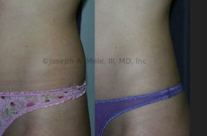 Out of tight low-rise jeans this muffin top may seem subtle, but Liposuction makes her curves even more shapely.