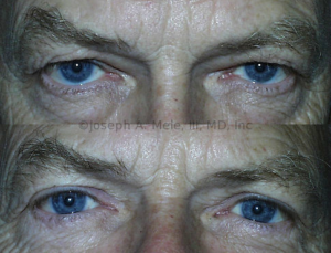 The Male Eyelid Lift (Male Blepharoplasty) above was performed to improve sight. Upper and lateral (outer) gaze was blocked by overhanging skin. The Blepharoplasty lifted the eyelids without distorting the eyebrows. Bags beneath the eyes were also reduced. Comparing the upper before and lower after pictures, he looks less angry and tired and more friendly and rested.