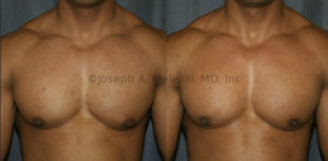 Before and After Gynecomastia Reduction - A well defined masculine chest is hard work, but sometimes being in incredible shape is still not enough. This patient works very hard for his physique. He had small amounts of natural breast tissue (gynecomastia) behind the areolas, his left greater than right.