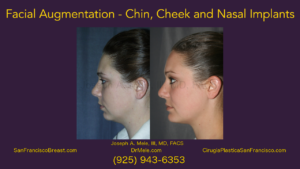 Facial Augmentation Video Presentation - chin, cheek and nasal implants before and after pictures