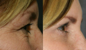 The Eyelid Lift or Blepharoplasty can remove the skin that hangs of the eyes and the bags that hang under the eyes.