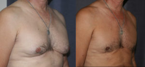 Gynecomastia and Skin Reduction - In this case the left picture shows enlarged breasts with disproportionate fat and glandular tissue, and sagging. The skin is folding onto itself at the base of the breasts. On the right is the after photo. The excess fat, gland and skin have been excised through an excision that runs along the base of the breast. As his tan shoes, this patient was happier both in and out of clothing after his breast reduction.